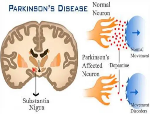 巴金森疾病是一種慢性且逐漸發展的中樞神經系統退化型疾病